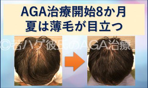 AGA8か月 夏は薄毛が目立つ