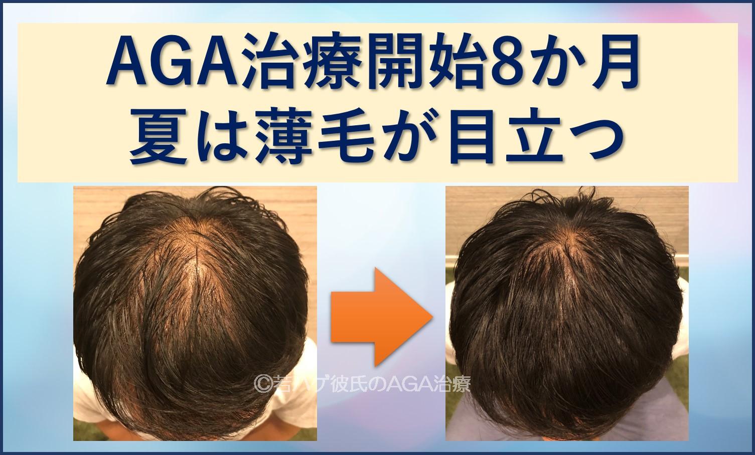 AGA8か月　夏は薄毛が目立つ