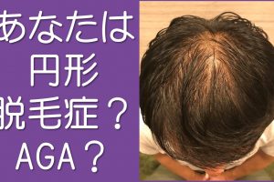 あなたは円形脱毛症?AGA?