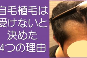 自毛植毛のメリットデメリット