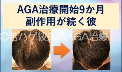 AGA治療9か月副作用が続く彼