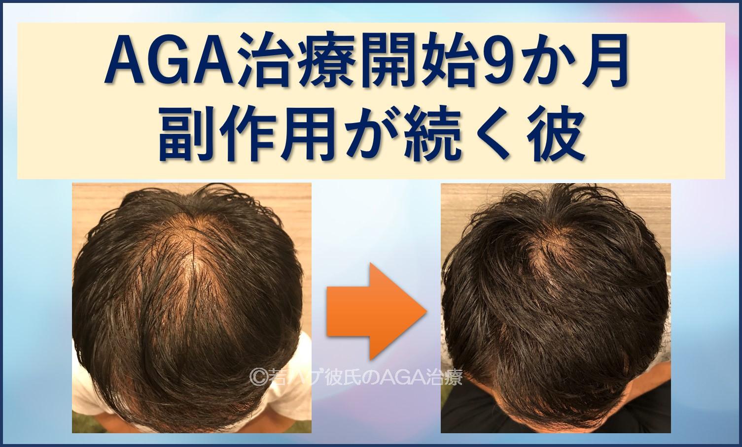 AGA治療9か月副作用が続く彼