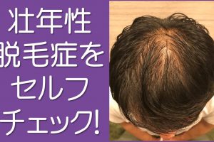 壮年性脱毛症をセルフチェック