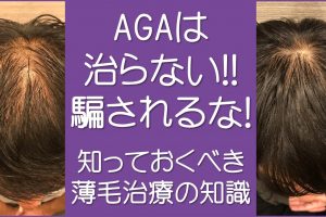 AGAは治らない！