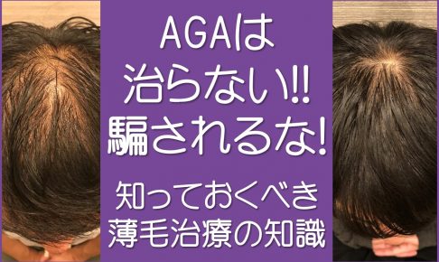 AGAは治らない！