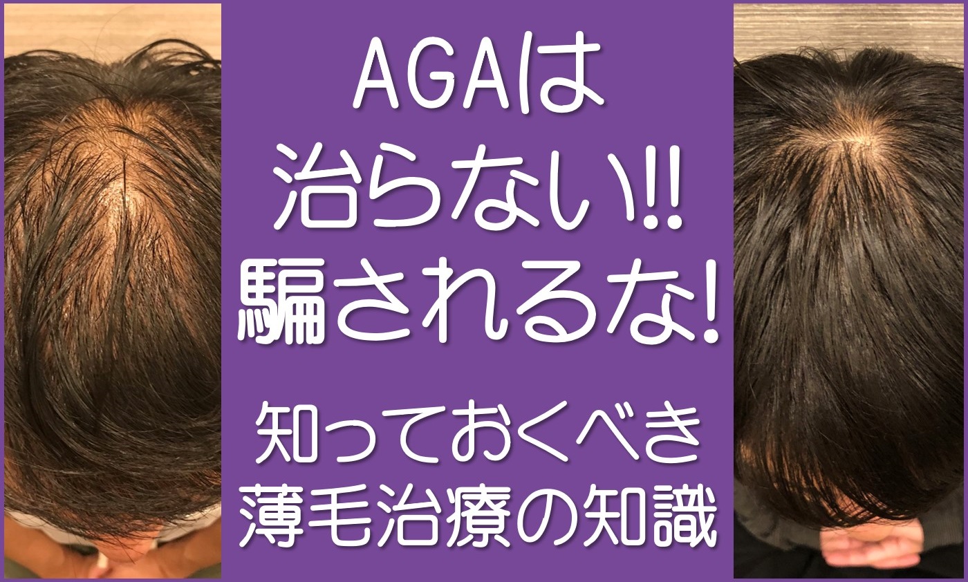 AGAは治らない！