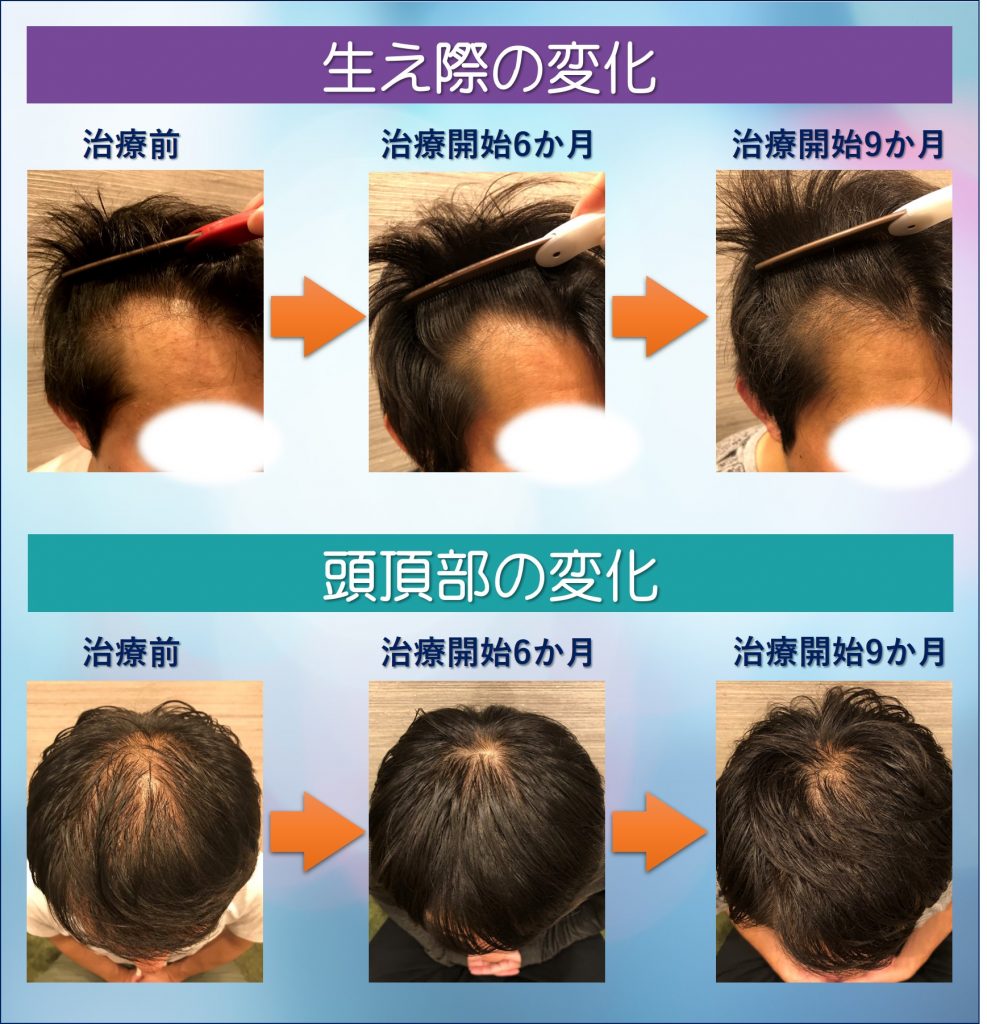 AGA治療生え際の変化