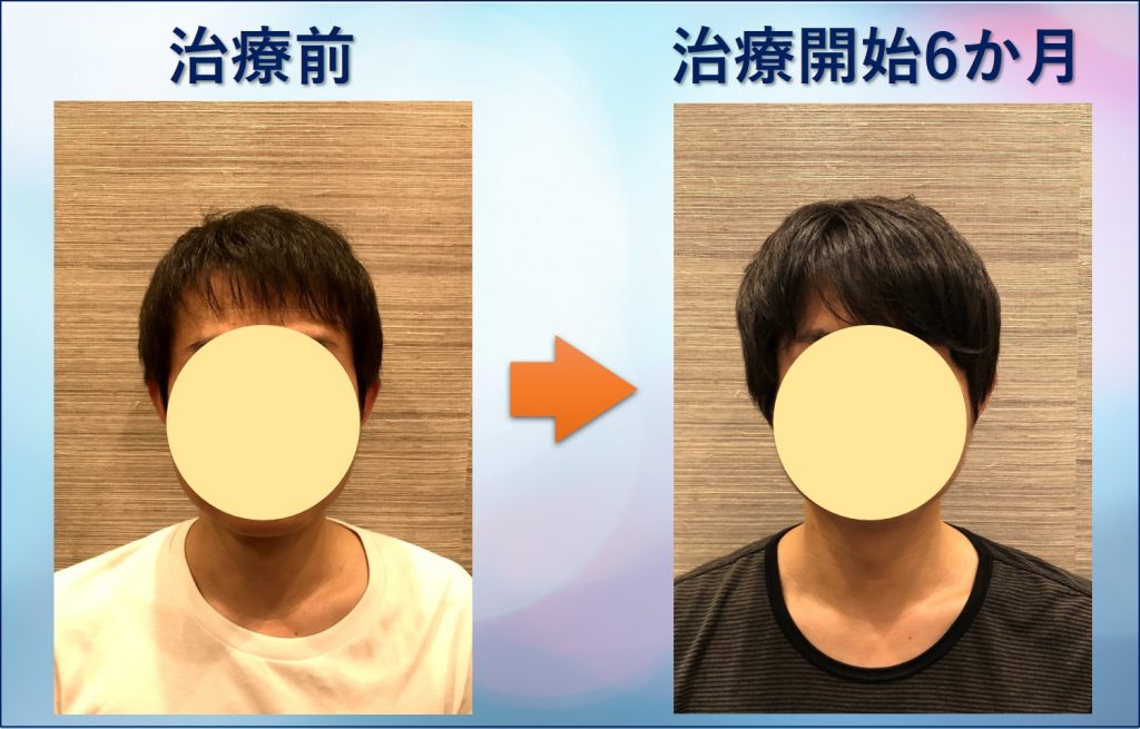 前髪が薄い男の変化