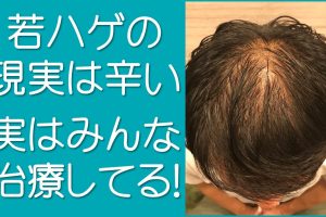 若ハゲの現実は辛い