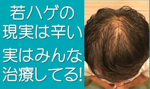 若ハゲの現実は辛い