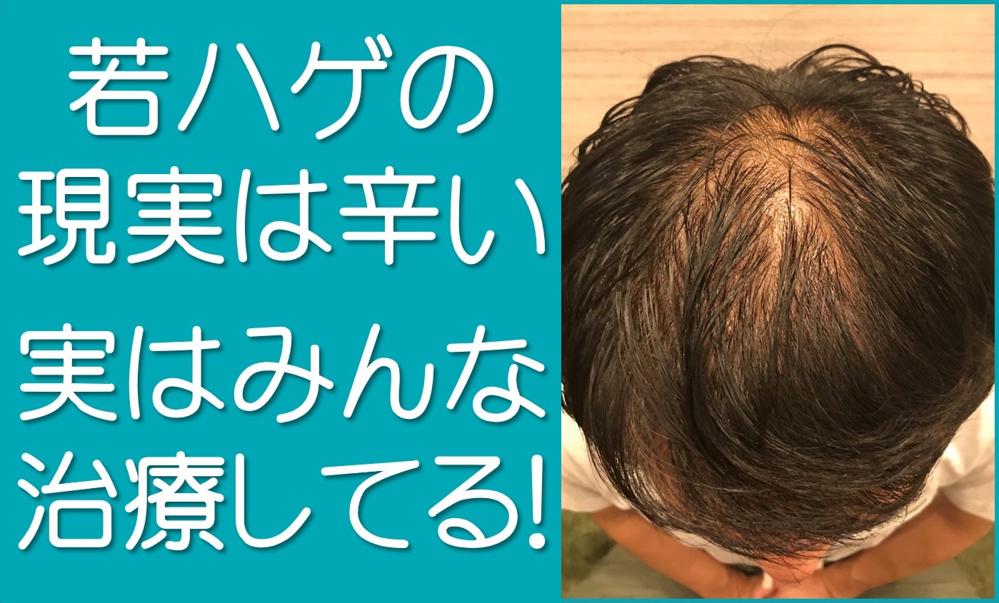 ハゲ 若
