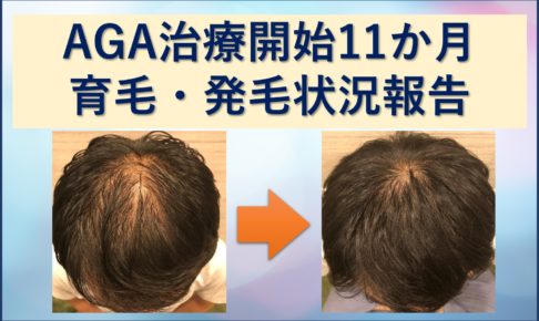 AGA治療11か月育毛・発毛ブログ