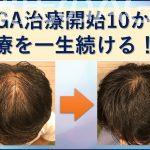 AGA治療一生続ける