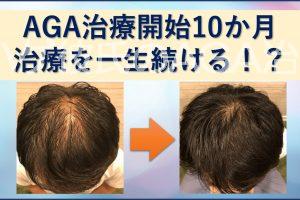 AGA治療一生続ける