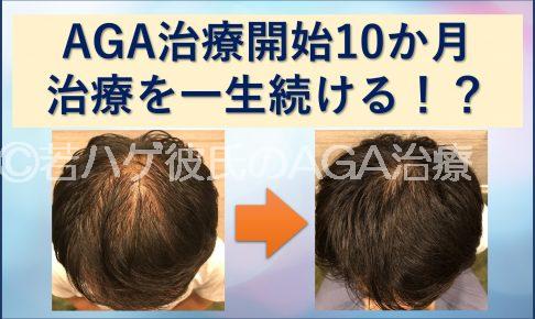 AGA治療一生続ける