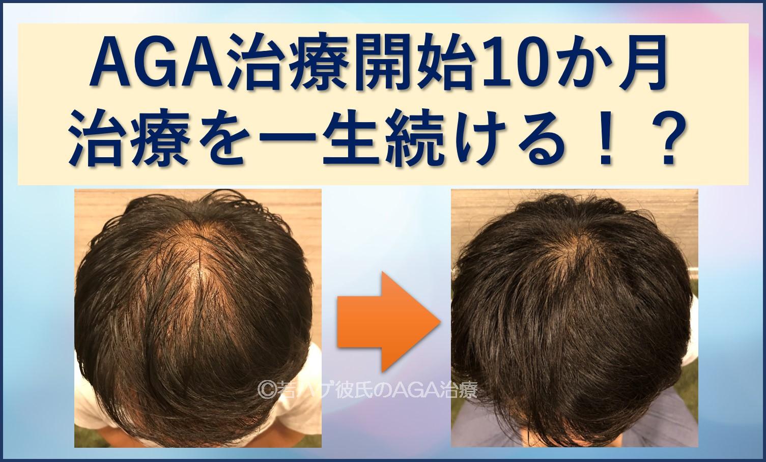 AGA治療一生続ける