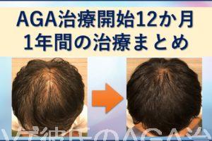 AGA治療1年間のまとめ