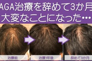 AGA治療やめて3か月の結果