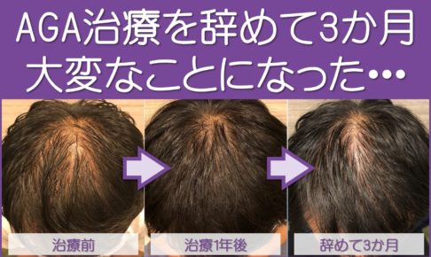 AGA治療やめて3か月の結果