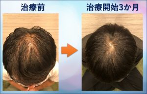 AGA治療3か月の状況