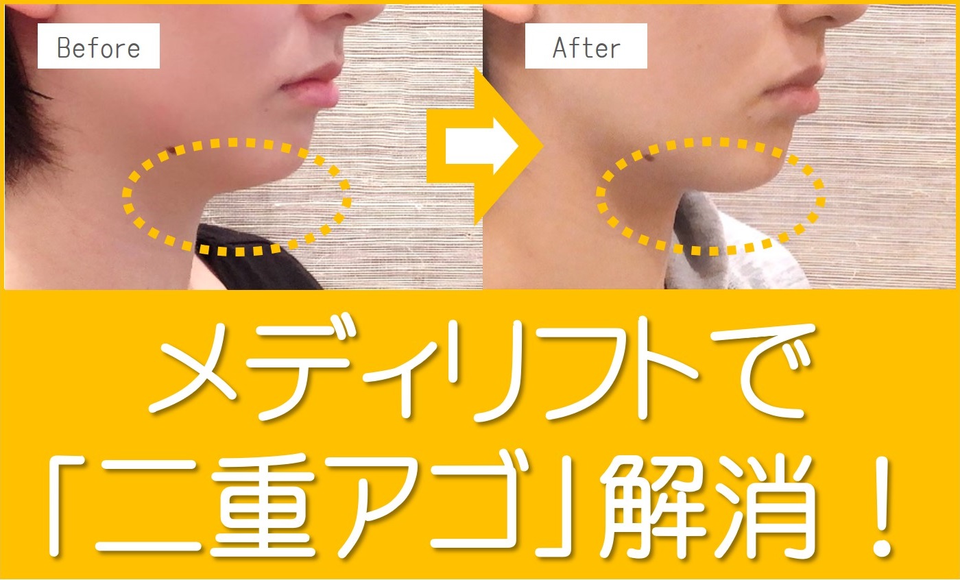 メディリフトで二重顎解消
